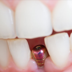 Cấy ghép ImPlant
