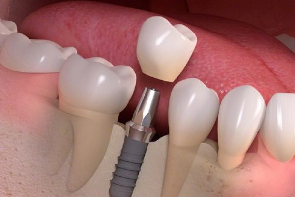 Cấy ghép Implant là gì?