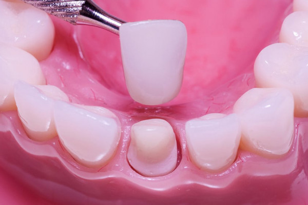 Bọc răng sứ thẩm mỹ có đau không, thời gian thực hiện bao lâu?